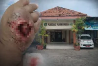 Foto: Kondisi tangan pasien usai pemasangan infus dan tampak depan Puskesmas Pasongsongan, Sumenep.